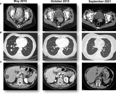 Case report: Metastatic urothelial cancer with an exceptional response to immunotherapy and comprehensive understanding of the tumor and the tumor microenvironment